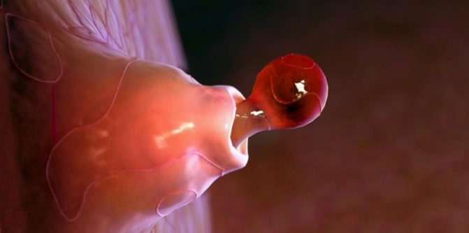 Rối loạn phóng noãn Đà Nẵng