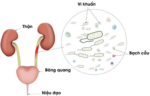Viêm đường tiết niệu Đà Nẵng